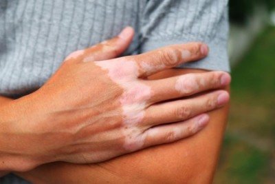 Em portadores da doença, o próprio sistema imune ataca as células produtoras de melanina, o que causa o surgimento de manchas brancas na pele  -  (crédito: Shutterstock))