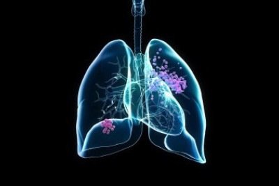 O CPCNP representa em torno de 85% de todos os tumores pulmonares e é frequentemente detectado em estágios avançados -  (crédito: Shutterstock/Fapesp)
