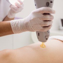 Cliente sofre queimadura em sessão de laser e Justiça aumenta indenização - Freepik