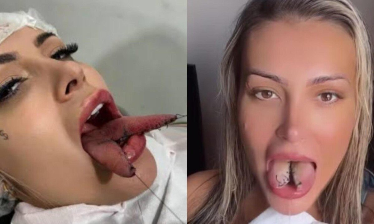 Bifurcação na língua: riscos e alertas de Andressa Urach após arrependimento - (crédito: Tupi)