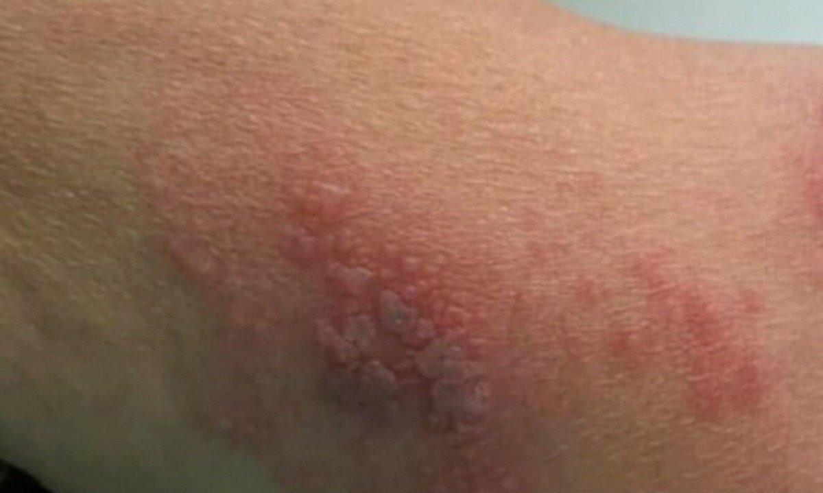 Herpes-zóster ainda não tem vacinação disponibilizada pelo SUS - Foto: Reprodução -  (crédito: Reprodução)