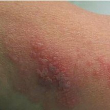 O avanço da Herpes