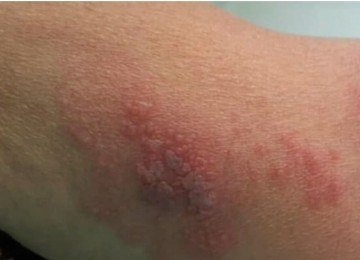 Herpes-zóster ainda não tem vacinação disponibilizada pelo SUS - Foto: Reprodução -  (crédito: Reprodução)