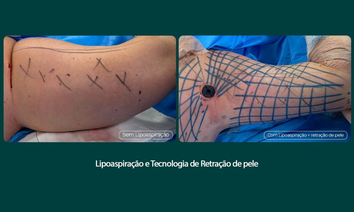 Tratamento remove flacidez do braço com tecnologia associada - (crédito: DINO)