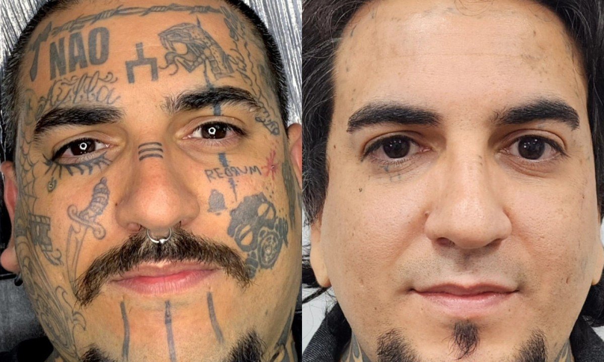 Remoção de tatuagem cresce e muda perfil de quem procura - (crédito: DINO)