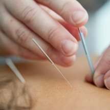 Fazer acupuntura durante a quimioterapia pode ajudar? Entenda - Katherine Hanlon/Unsplash