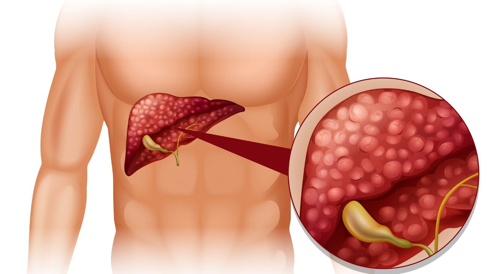 A progress&atilde;o da gordura no f&iacute;gado para fibrose e cirrose &eacute; uma preocupa&ccedil;&atilde;o, com altera&ccedil;&otilde;es na estrutura do &oacute;rg&atilde;o -  (crédito: Magnific)