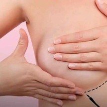 Outubro Rosa: seis dúvidas sobre tratamento do câncer de mama - Sociedade Brasileira de Mastologia/divulgação