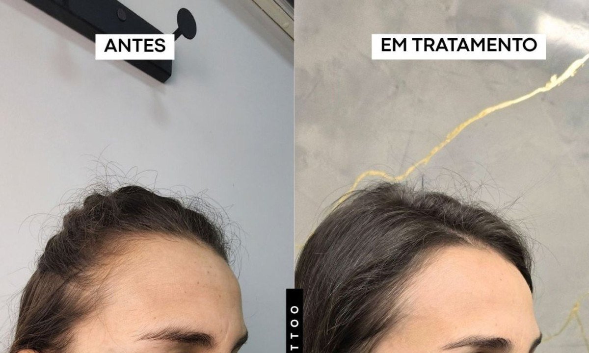 Nevo de Ota pode ser tratado com laser, explica biomédico - (crédito: DINO)