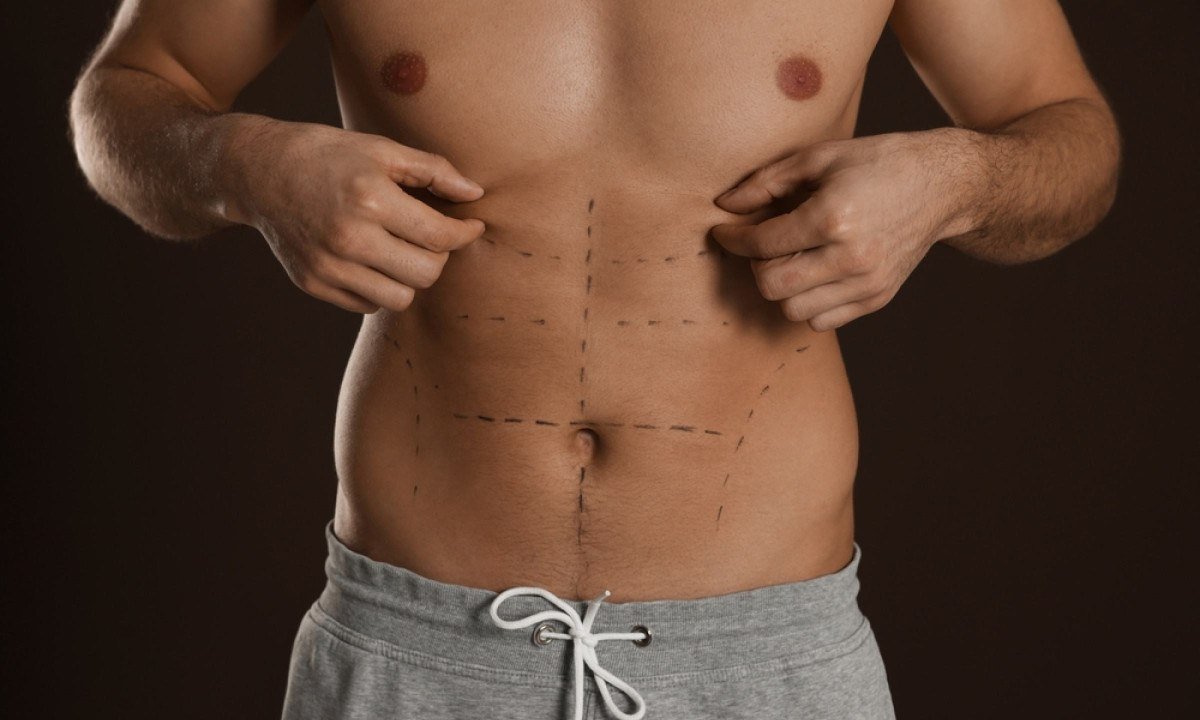 Definição em foco: a evolução da lipoaspiração masculina
- (crédito: Shutterstock)