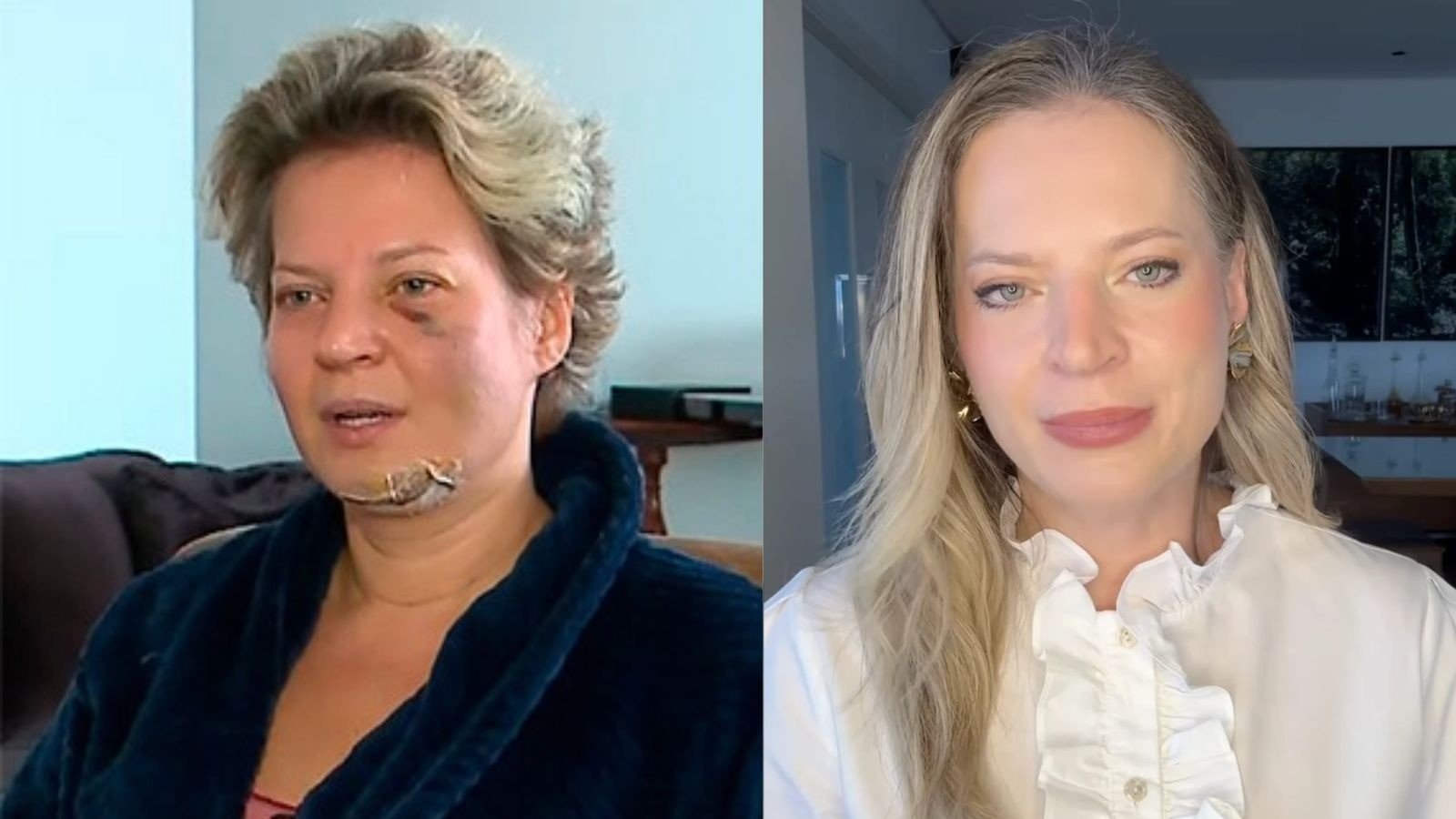 Joice Hasselmann em registros que mostram as les&otilde;es que sofreu em 2021 e sua apar&ecirc;ncia atual -  (crédito: Reprodu&ccedil;&atilde;o/SBT e @joicehasselmannoficial)