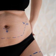 Lipoaspiração não é emagrecimento: confira 5 cuidados pré e pós-cirúrgicos - magnific