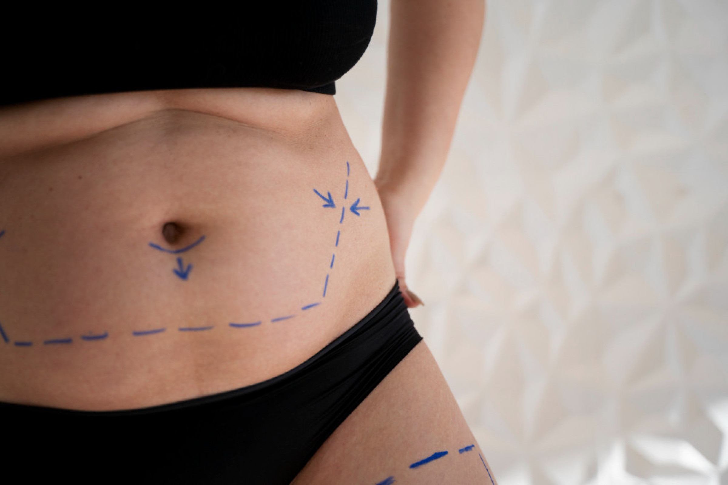 Lipoaspiração não é emagrecimento: confira 5 cuidados pré e pós-cirúrgicos