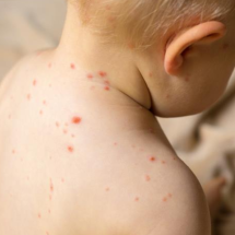 Secretaria de Saúde descarta dois casos de sarampo em Uberlândia  - Shutterstock