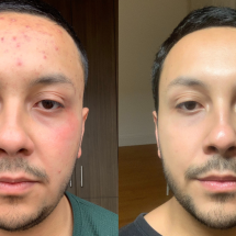 O que aprendi em minha desesperada busca por solução para acne severa - Santiago Vanegas