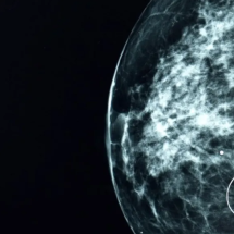 A ferramenta de IA capaz de detectar tumores que passaram desapercebidos por médicos - BBC