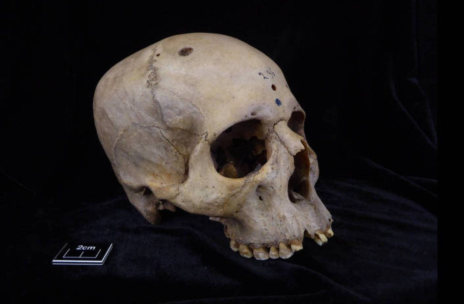 Marcas em crânio egípcio de 4 mil anos sugerem tentativa de tratar câncer