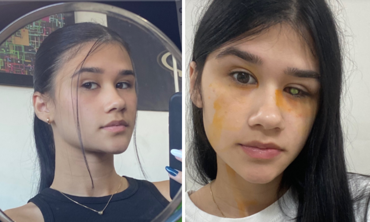 Jovem perdeu visão após infecção causada pelas lentes de contato -  (crédito: TikTok / Lara Brandão Tironi )