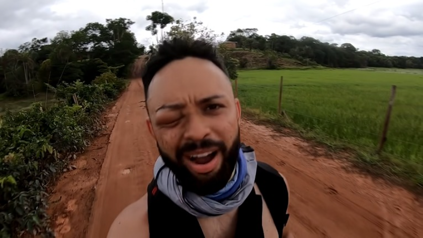 Após as ferroadas, ele descobriu que é alérgico: “Quase perco meu olho 