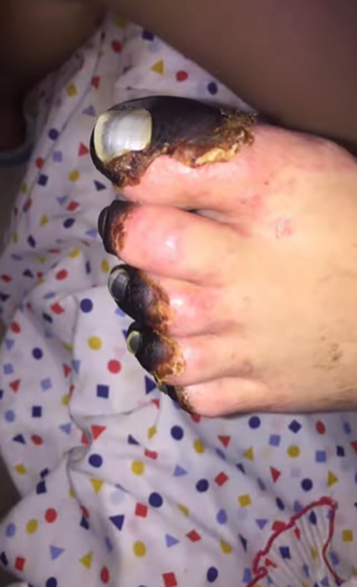 Durante a recuperação, porém, seu pé esquerdo começou a necrosar. E aí começou mais uma batalha, para combater uma infecção no osso. 