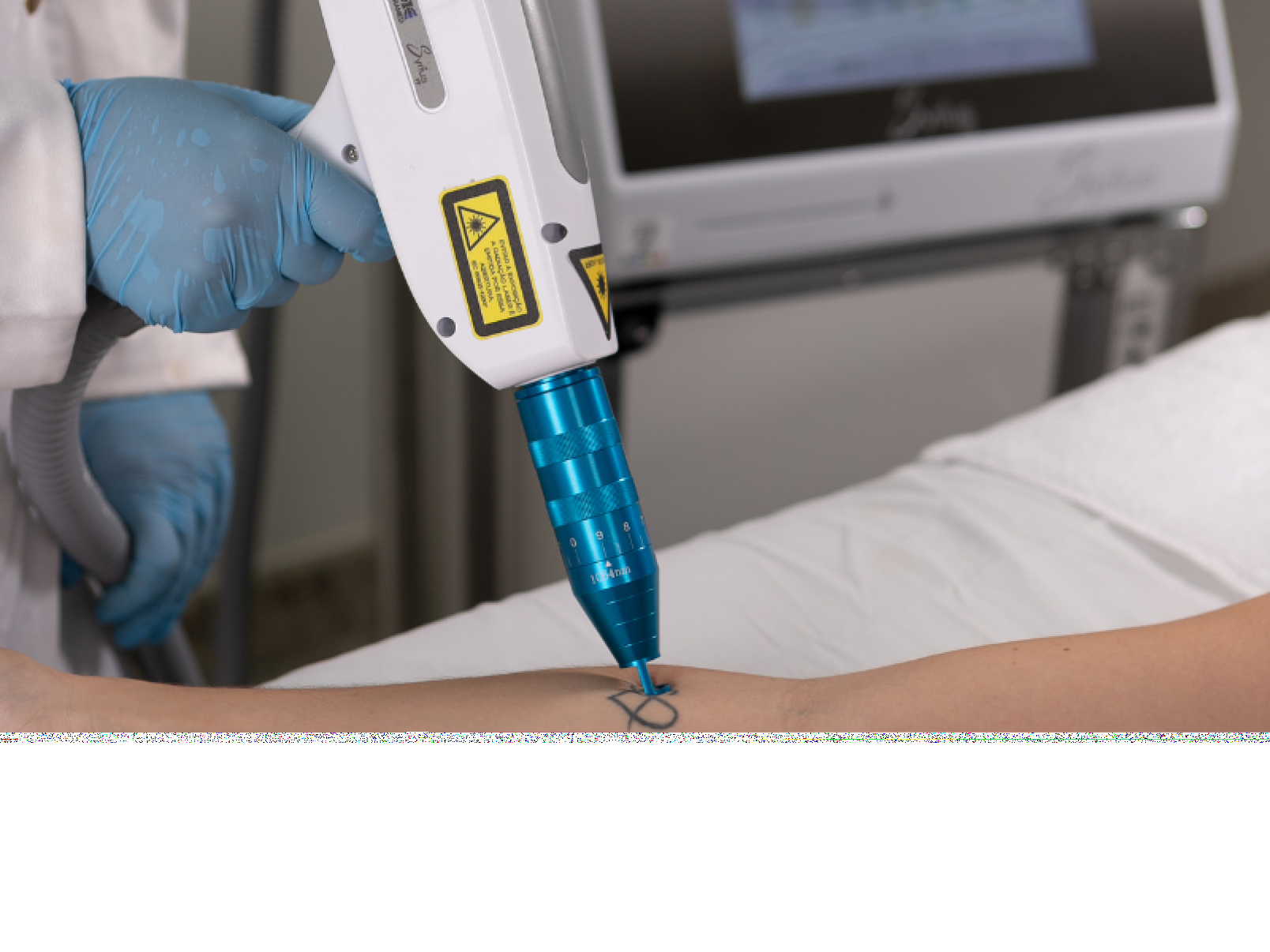 Procura por remoção de tatuagens cresce no Brasil - DINO
