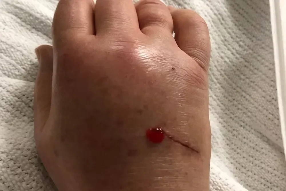 Segundo especialistas, quem encontra um ornitorrinco ferido, deve gravar vÃ­deos, tirar fotos e enviar a equipes responsÃ¡veis por resgate de animais selvagens. Nunca deve pegar o animal.  Ao relatar a tentativa de resgate, Forward disse que sentiu uma  dor repentina e insuportÃ¡vel e, logo, percebeu que o esporÃ£o estava fixado em sua mÃ£o.