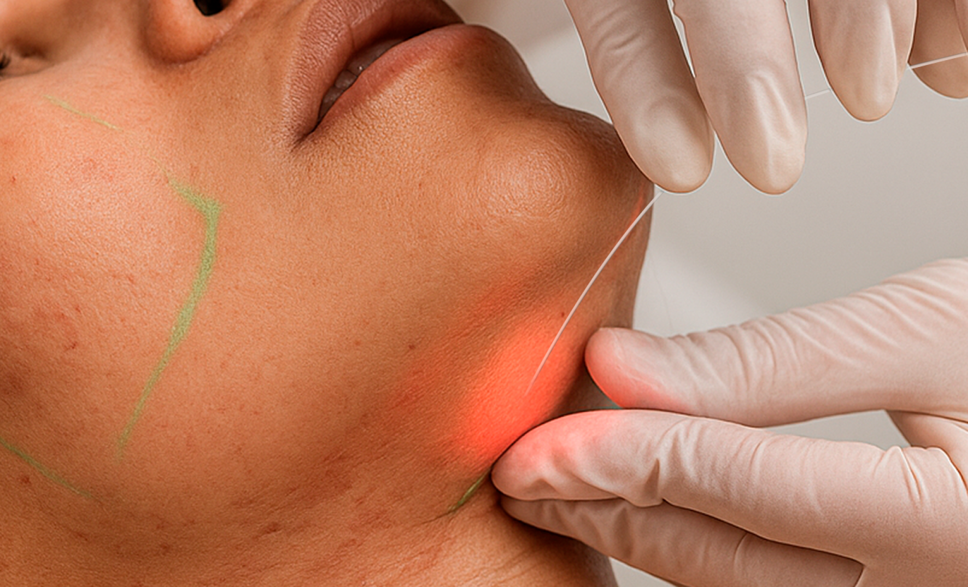 Laser subdérmico surge como alternativa à lipoaspiração - DINO