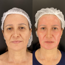 Pacientes estrangeiros desembarcam em Belo Horizonte em busca do APhen Peel® com o Dr. Lucas Miranda - Redes Sociais (@drlucasmiranda.dermato)