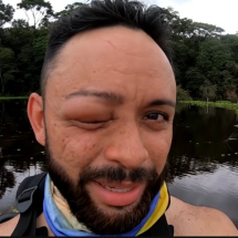 Pra quem não viu: Ataque de vespas deixou Youtuber com rosto desfigurado - - Reprodução/Youtube