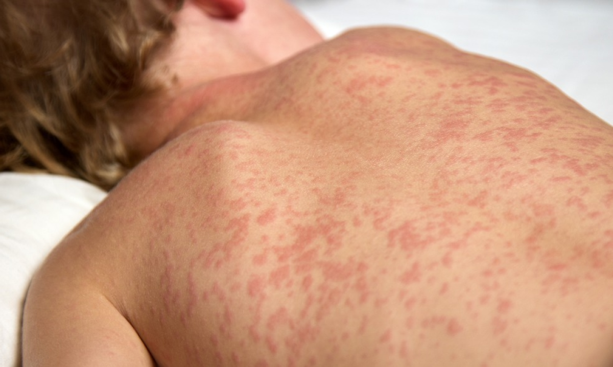 Sarampo no Brasil: quais estados registraram casos da doença em 2025? - Reprodu&ccedil;&atilde;o/ Internet