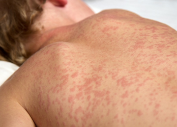 Manchas vermelhas na pele s&atilde;o um dos sintomas cl&aacute;ssicos do sarampo, doen&ccedil;a que voltou a preocupar no Brasil. -  (crédito: Reprodu&ccedil;&atilde;o/ Internet)