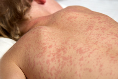 Manchas vermelhas na pele s&atilde;o um dos sintomas cl&aacute;ssicos do sarampo, doen&ccedil;a que voltou a preocupar no Brasil. -  (crédito: Reprodu&ccedil;&atilde;o/ Internet)