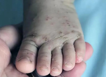 SES monitora surto de sarna humana no Centro-Oeste de Minas -  (crédito: Foto: MinistÃ©rio da SaÃºde)