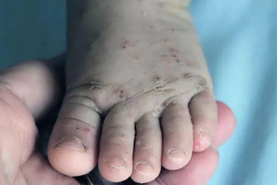 SES monitora surto de sarna humana no Centro-Oeste de Minas -  (crédito: Foto: MinistÃ©rio da SaÃºde)