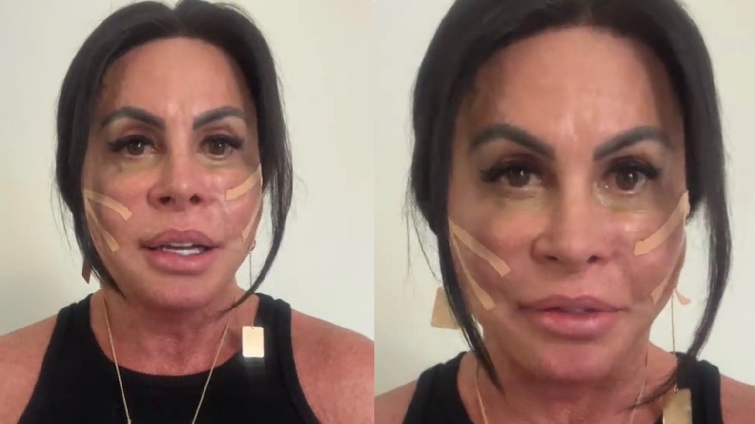 Gretchen troca PMMA por peptídeos e dita tendência na estética