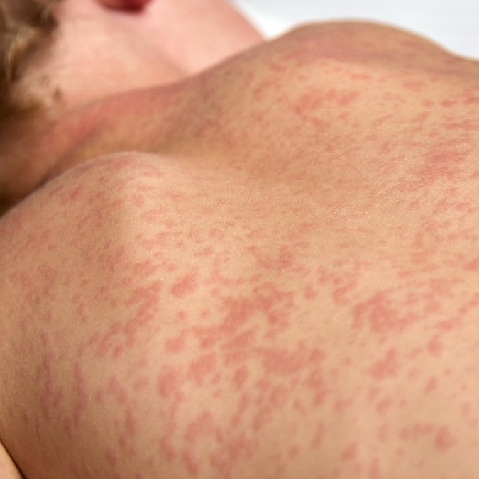 Sarampo em crianças com menos de 5 anos pode causar pneumonia e sequelas neurológicas - Reprodu&ccedil;&atilde;o / Redes sociais