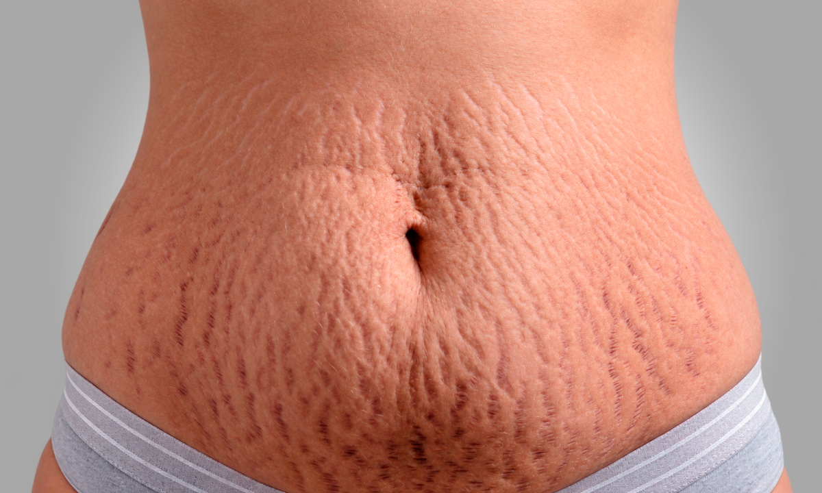 Cirurgia plástica e estética se aliam contra as estrias - (crédito: DINO)