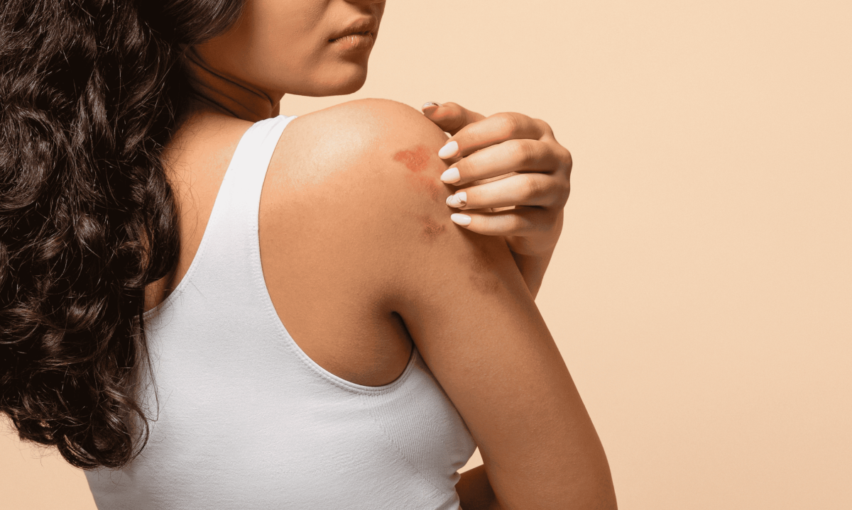 Mês da Dermatite Atópica: os impactos da doença na pele - (crédito: DINO)