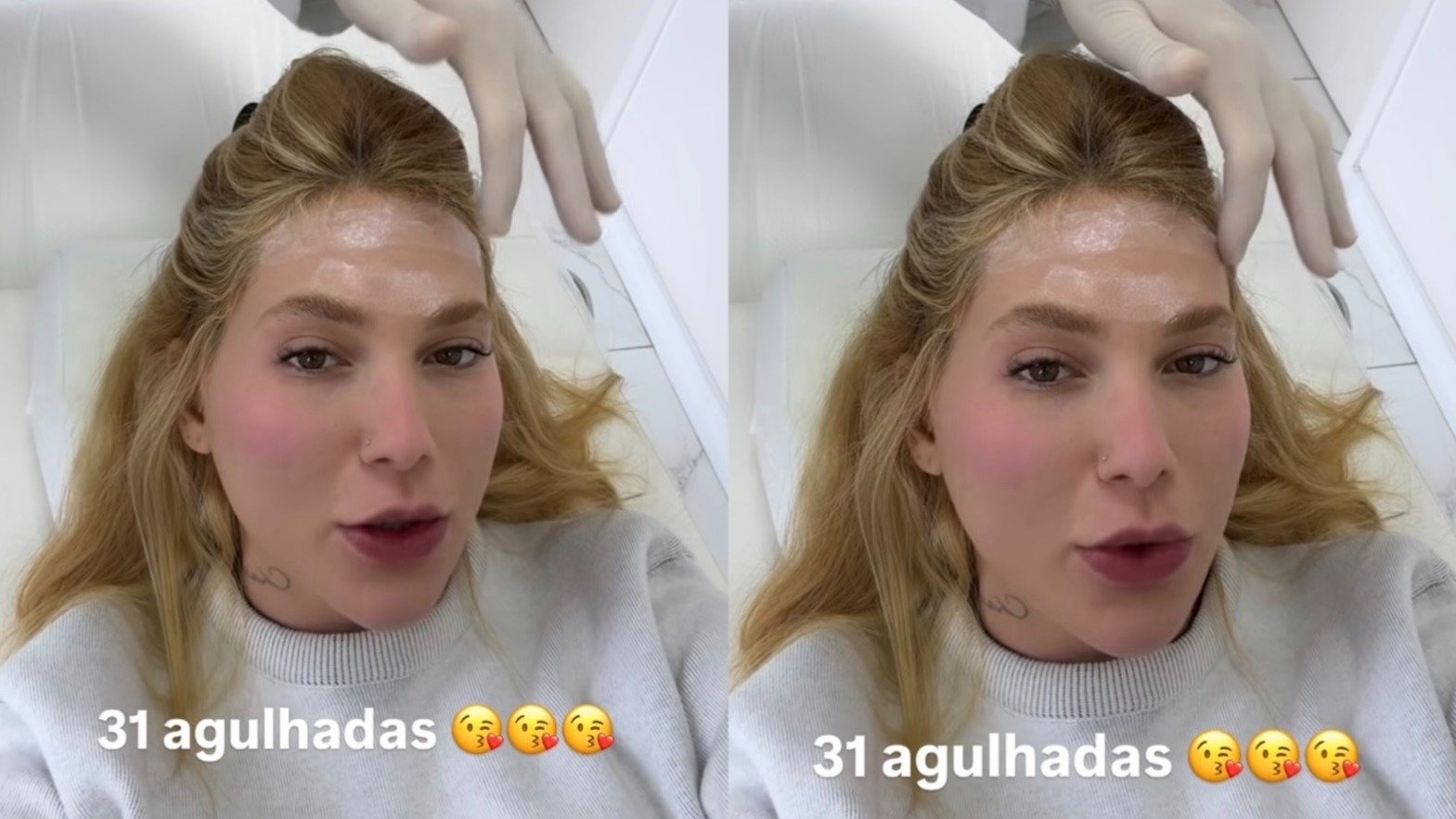 Virginia Fonseca durante sess&atilde;o de 31 aplica&ccedil;&otilde;es de toxina botul&iacute;nica para tratamento de enxaqueca -  (crédito: Redes sociais)