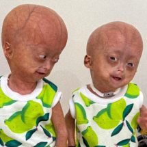 Elis Lima Carneiro: morre aos 5 anos gêmea com rara síndrome de envelhecimento - Reprodu&ccedil;&atilde;o/Instagram @elis_e_eloa