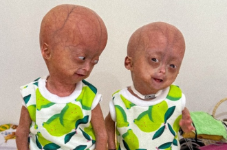 Elis Lima Carneiro: morre aos 5 anos gêmea com rara síndrome de envelhecimento