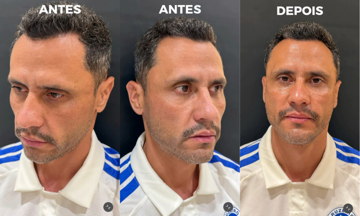 Menos de 24 horas depois de ser eleito governador de Minas Gerais, Cleitinho Azevedo (Republicanos) passou por procedimentos estéticos no rosto - (crédito: Reprodução/Redes Sociais)