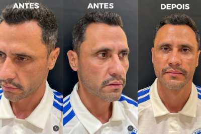 Menos de 24 horas depois de ser eleito governador de Minas Gerais, Cleitinho Azevedo (Republicanos) passou por procedimentos estéticos no rosto -  (crédito: Reprodução/Redes Sociais)