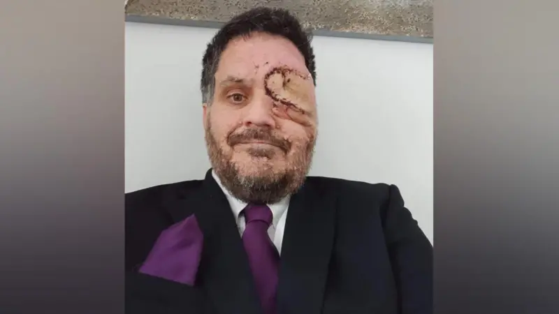 'Fui expulso de restaurante por causa de meu rosto desfigurado'