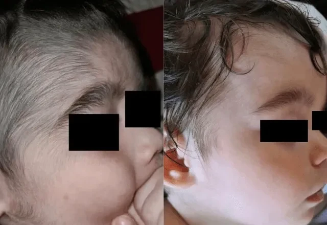 Crianças que tiveram contato com minoxidil podem apresentar crescimento anormal de pelos  -  (crédito: Reprodução/Journal Of Dermatology)