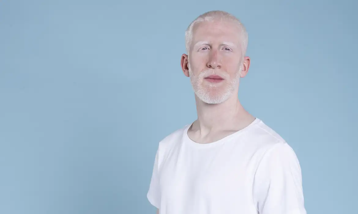 Sem a prevenção, albinos envelhecem precocemente e podem desenvolver cânceres de pele agressivos antes dos 30 anos de idade -  (crédito:  Freepik/Divulgação)