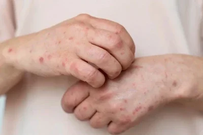 A sarna humana se manifesta com les&otilde;es avermelhadas e coceira intensa, sendo as m&atilde;os uma das regi&otilde;es frequentemente afetadas pela condi&ccedil;&atilde;o -  (crédito: Freepik)