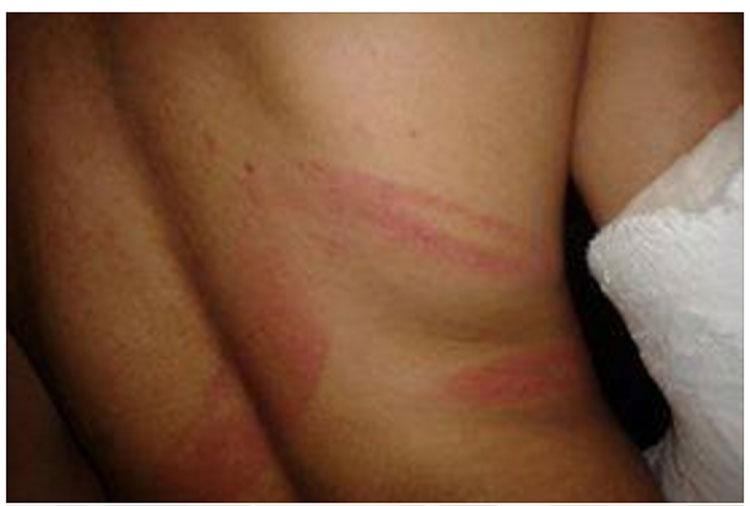 Em ataque homofóbico, assaltantes usam barra de ferro para quebrar braço de jovem após bloco de carnaval em BH