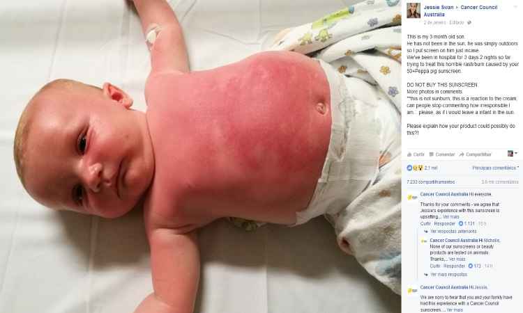 Bebê é internado na Austrália após uso de protetor solar - Cancer Council Australia/Facebook 