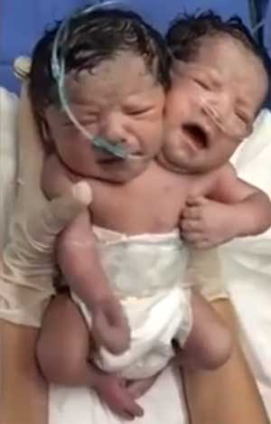 Morre bebê que nasceu com duas cabeças - Reprodução/youtube